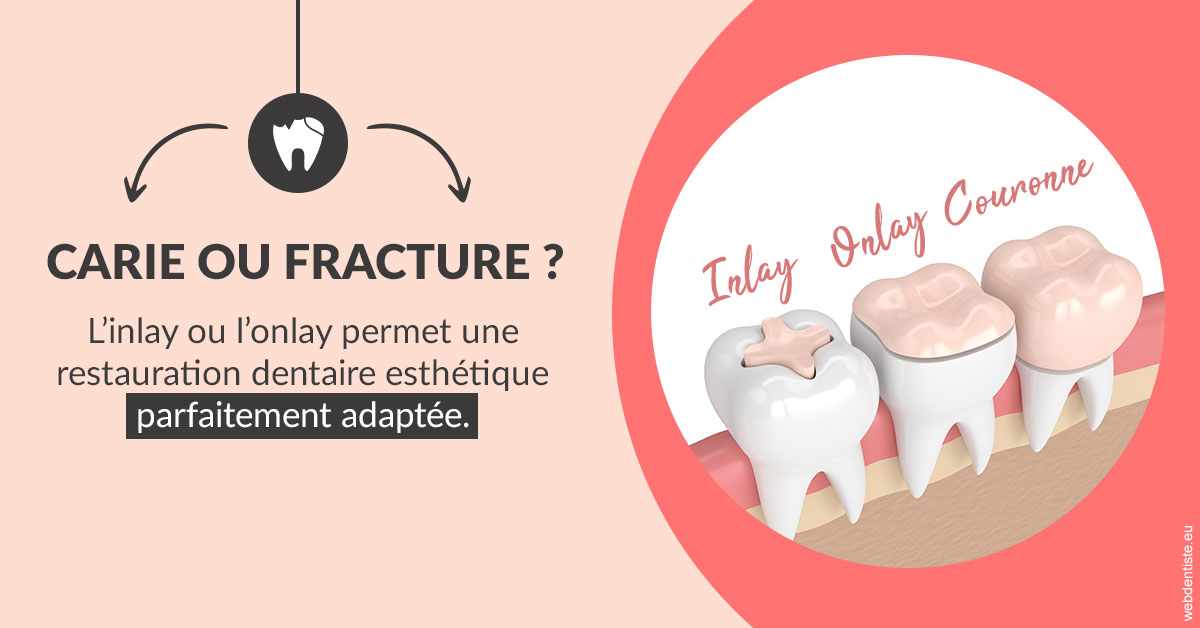 https://dr-justin-laurence.chirurgiens-dentistes.fr/T2 2023 - Carie ou fracture 2