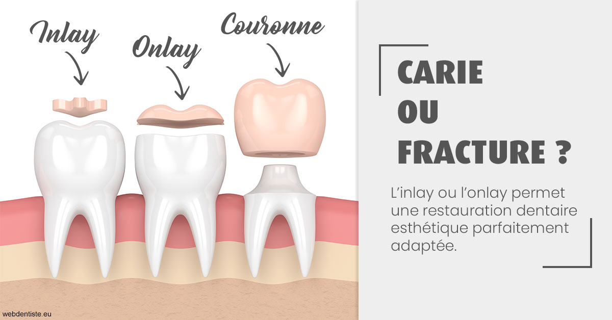 https://dr-justin-laurence.chirurgiens-dentistes.fr/T2 2023 - Carie ou fracture 1