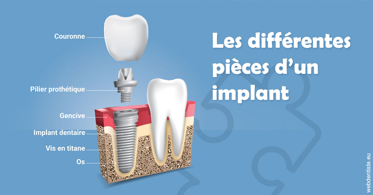 https://dr-justin-laurence.chirurgiens-dentistes.fr/Les différentes pièces d’un implant 1